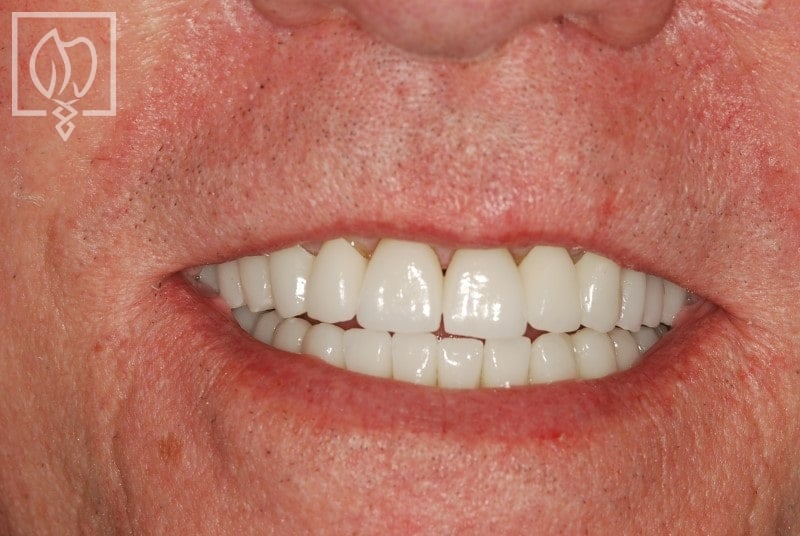 Full Mouth Rejuvenation with Sedation After