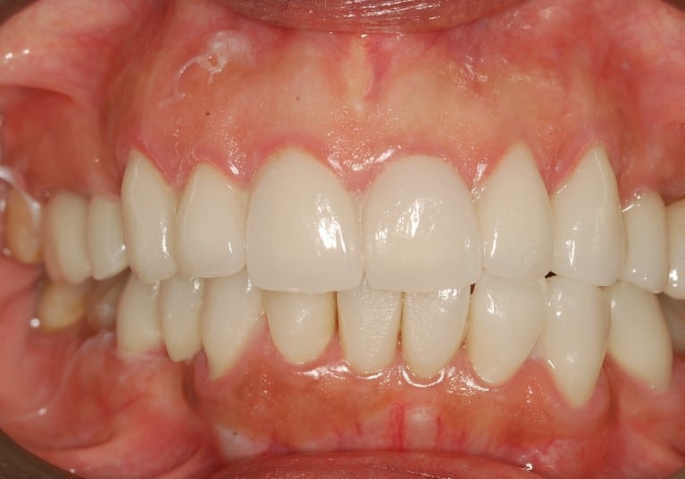 After Porcelain crowns rejuvenating the Tetracycline Stained Dentition
