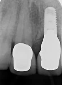 dental implant scan after bone graft Bethesda