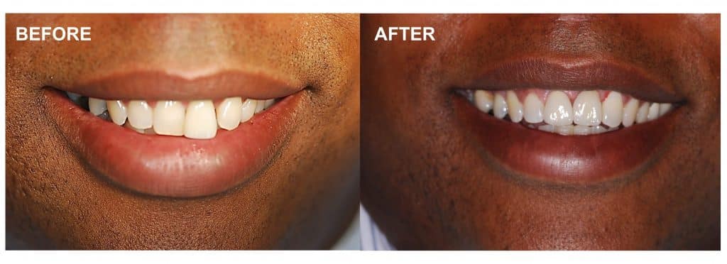 before after dental implant with bone graft