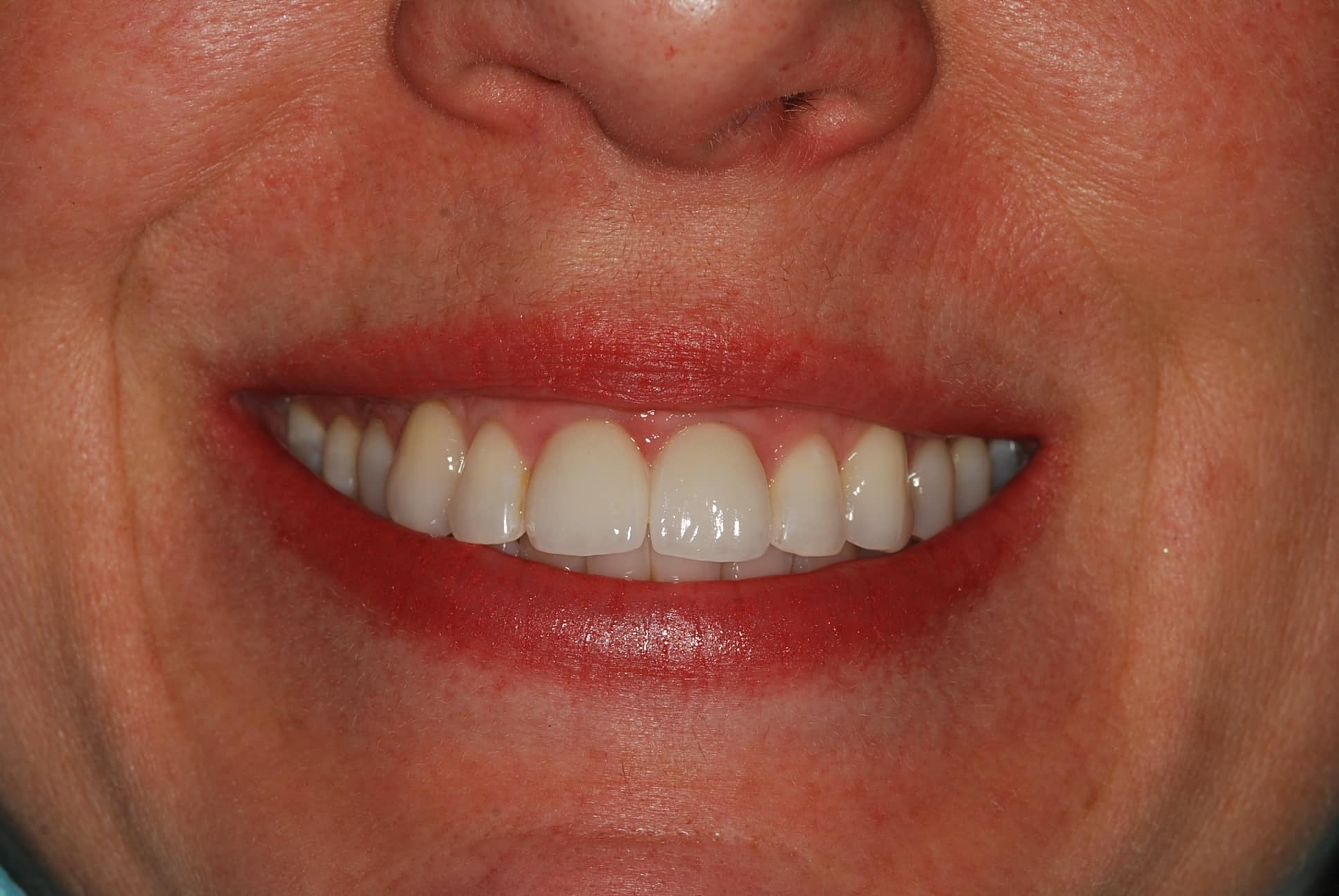before after discolored teeth and gap Bethesda
