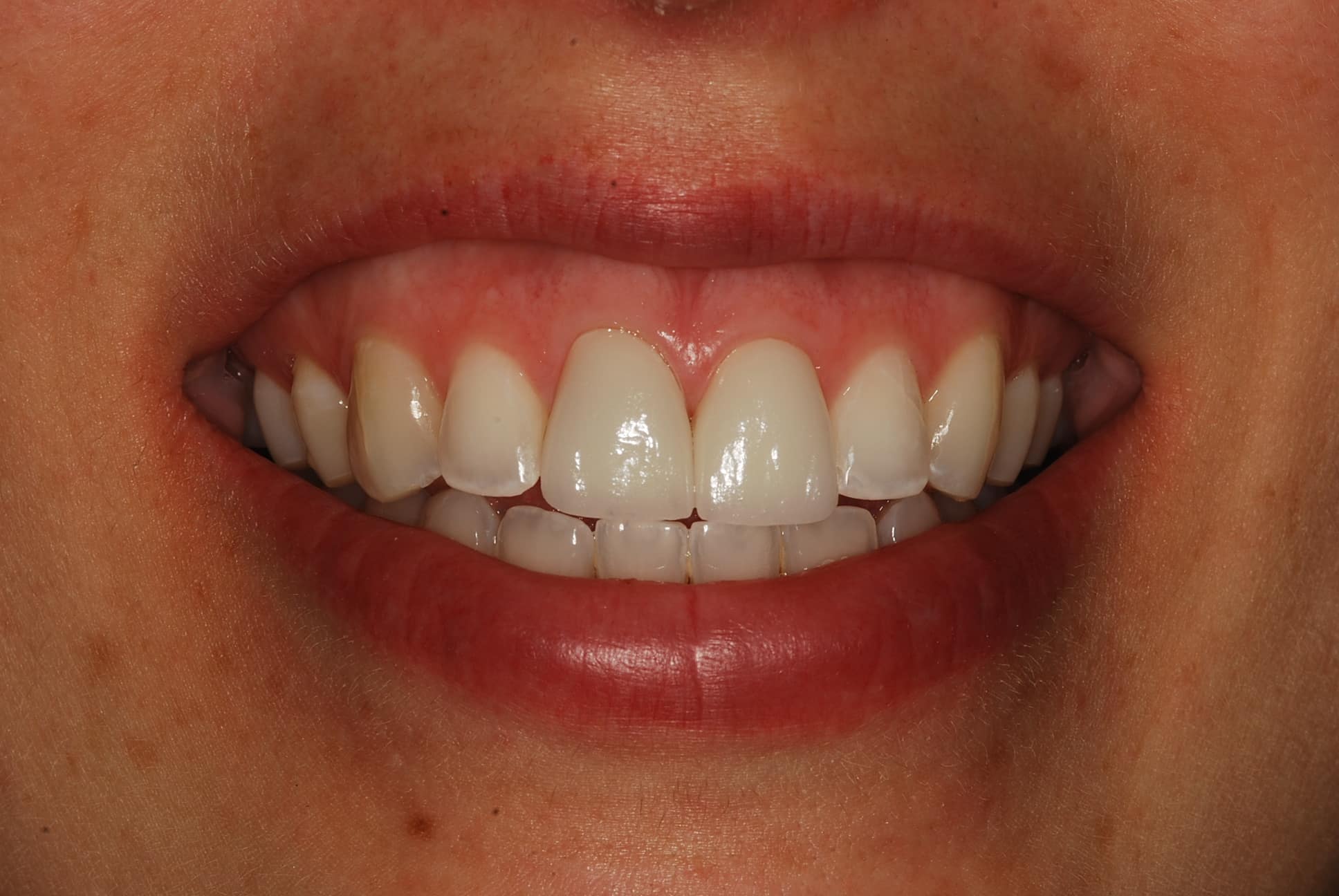 Patient before and after chipped teeth washington DC