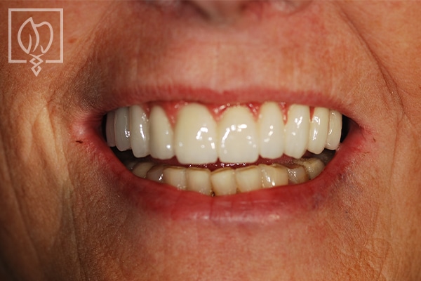 Smile restoration with dental crowns