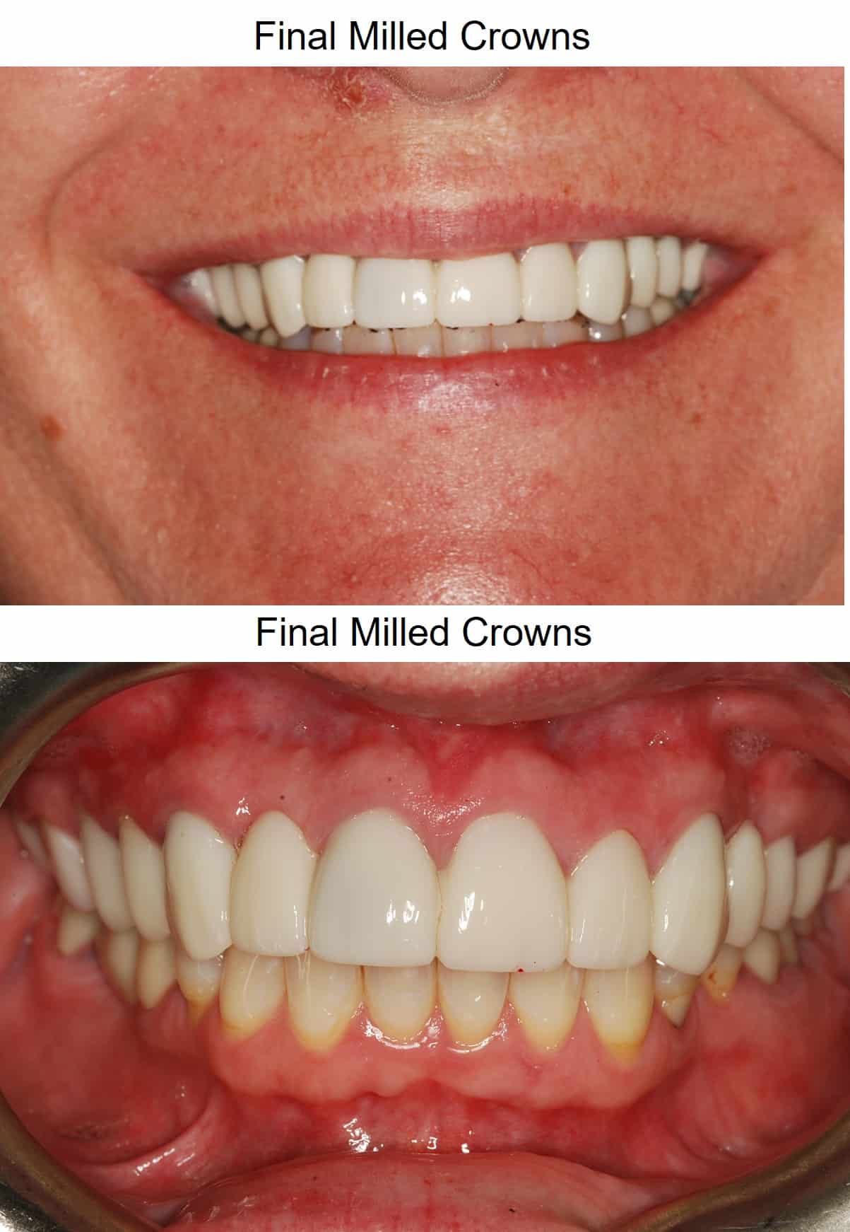 final milled crowns