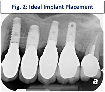 ideal-implant-placement-1
