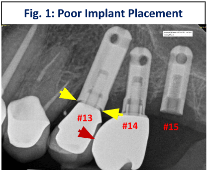 poor-implant-placement-1