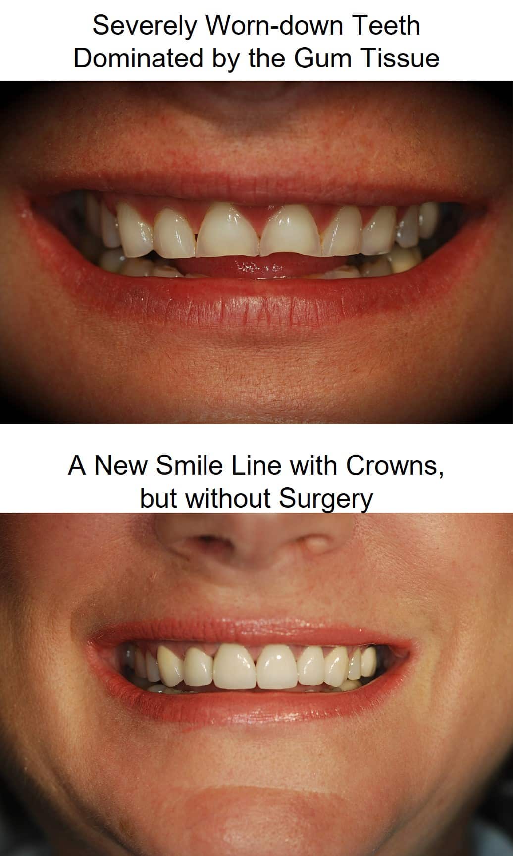 before after gummy smile dental crowns