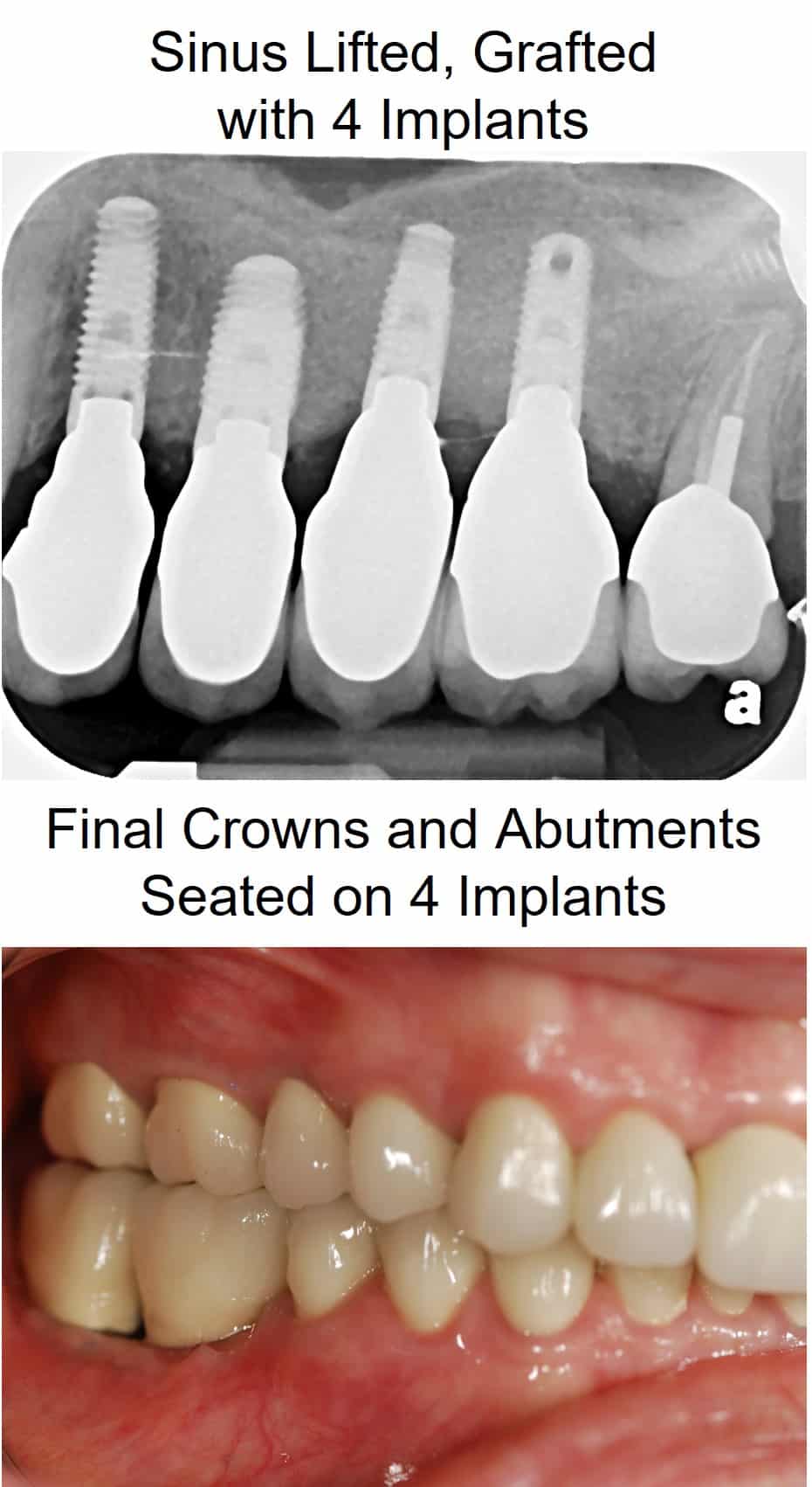 Sinus lift dental implants crowns Bethesda