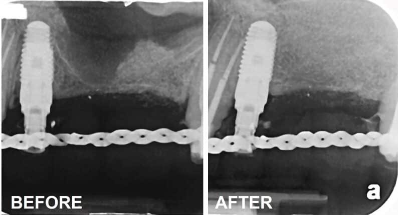 Before after sinus lift dental implants Washington DC