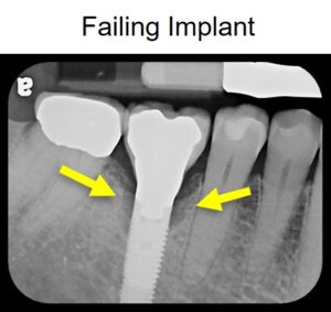 Failing Implant 8 061219