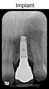 Rotrosen #8 2015 implant