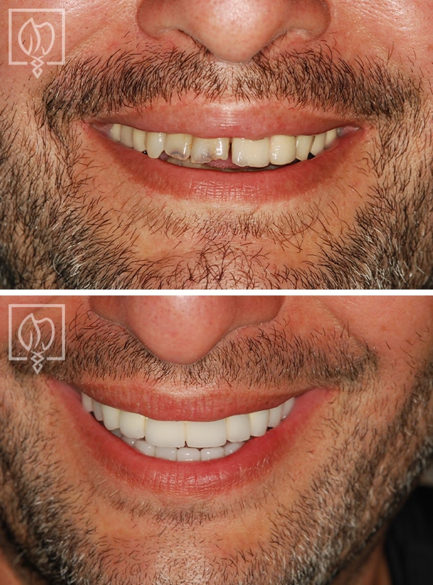 a-revitalized-smile-creating-a-recharged-confidence before after