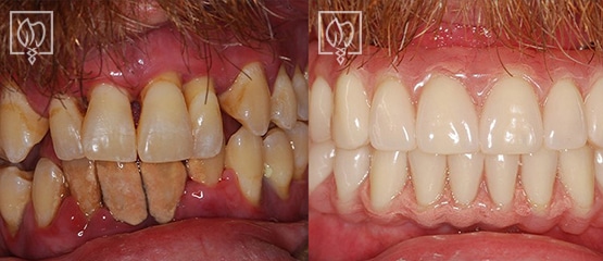 Before after Same Day/All-on-4&6 ® Dental Implants Potomac MD