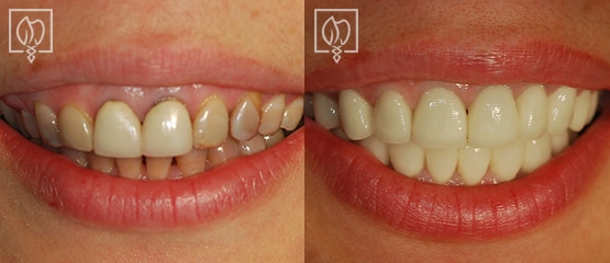 Before after cosmetic smile makeover Chevy Chase