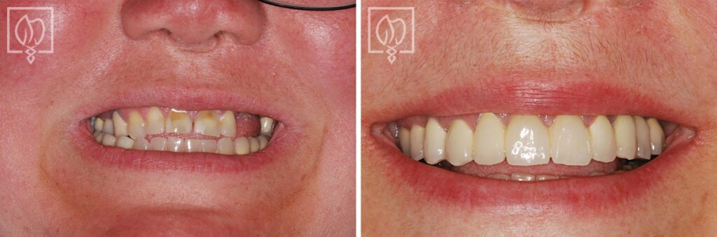 discolored teeth before and after prosthodontist Washington DC