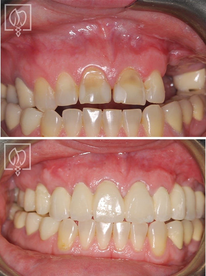 discolored teeth before and after prosthodontist Washington DC