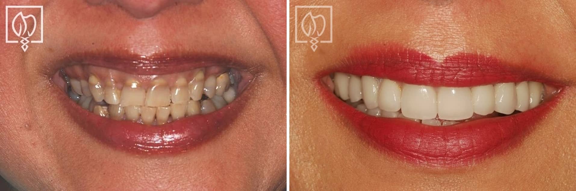dental-crown-smile-makeovers-discolored-teeth-transformations-dental-crowns-severely-discolored-dentition--5843 before after
