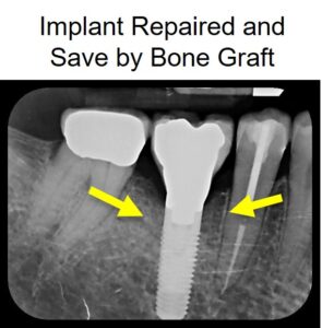 failing implant repaired 14 122219