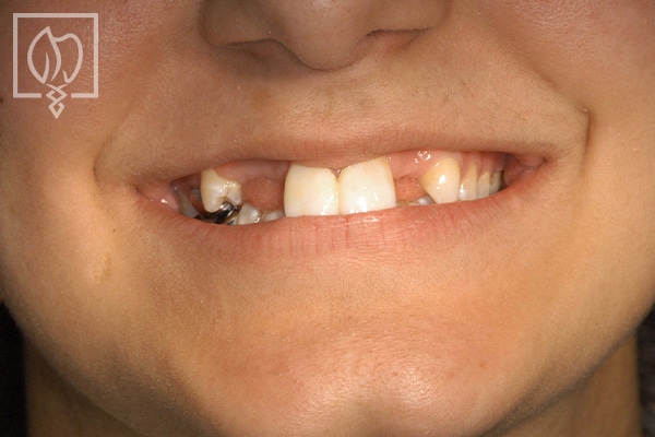 Dental Implant Before After Patient Northern Virginia
