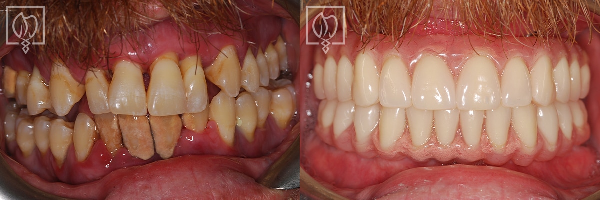 Same Day All On 4 Dental Implant Before After Gallery Potomac