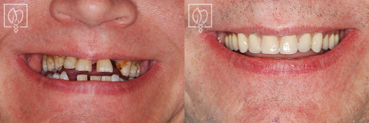 Same Day All On 4 Dental Implant Before After Gallery Washington DC