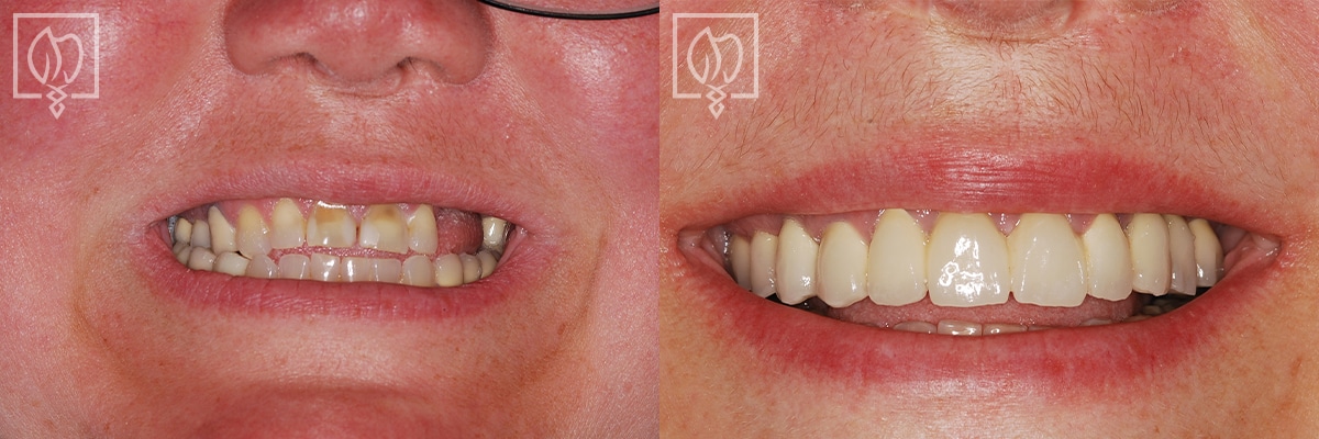 Dental Implant Before After Patient Potomac