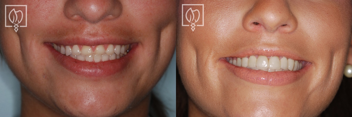 Cosmetic Smile Makeover Before After Gallery Northern Virginia