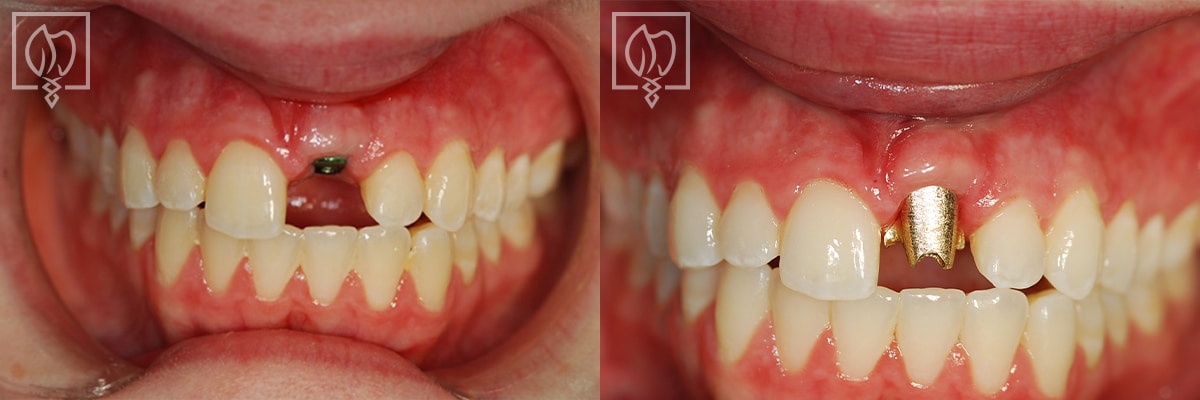 Dental Implant Before After Patient Chevy Chase