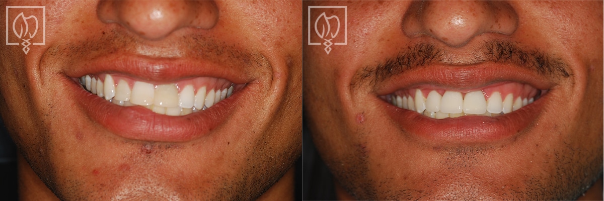 Cosmetic Smile Makeover Before After Gallery Washington DC