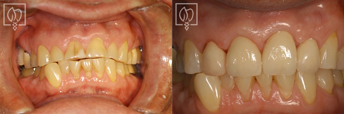 Discolored Teeth Before After Gallery Washington DC