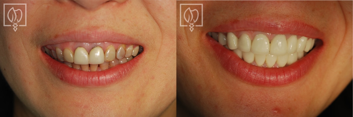Discolored Teeth Before After Gallery Northern Virginia