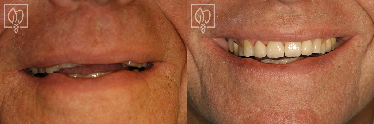 Discolored Teeth Before After Gallery Bethesda MD