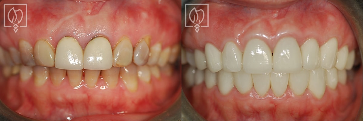 Discolored Teeth Before After Gallery Potomac MD