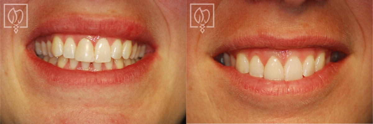 Cosmetic Smile Makeover Before After Gallery Northern Virginia