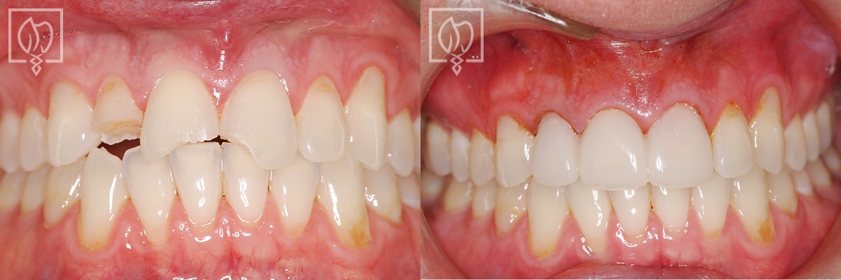 Temporary Dental Restorations Before After Gallery Washington DC