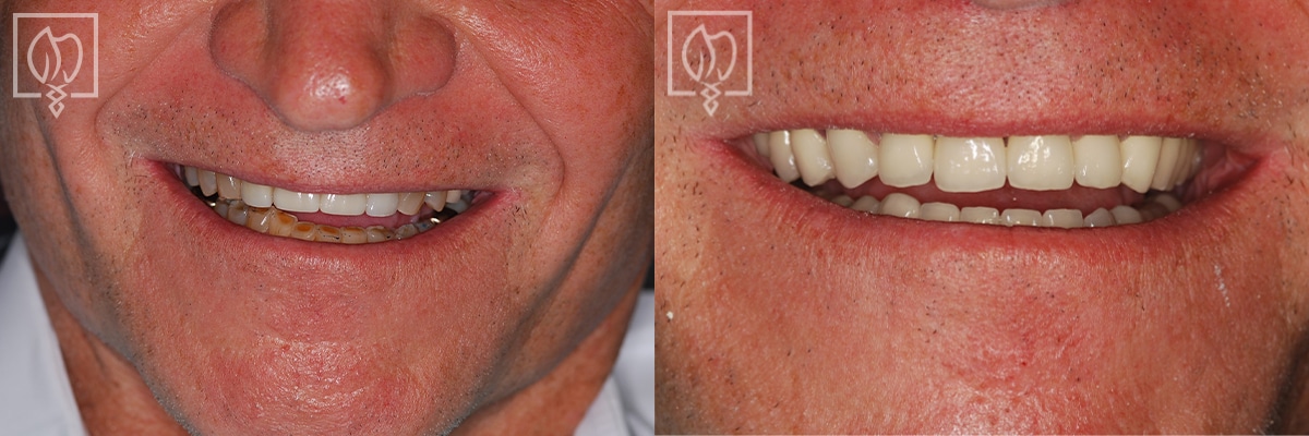 Full Mouth Reconstruction Before After Gallery Bethesda MD
