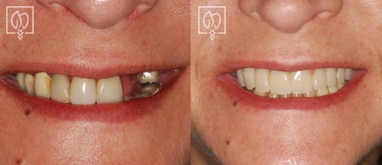 Before after Full Mouth Reconstruction Without Implants Northern Virginia