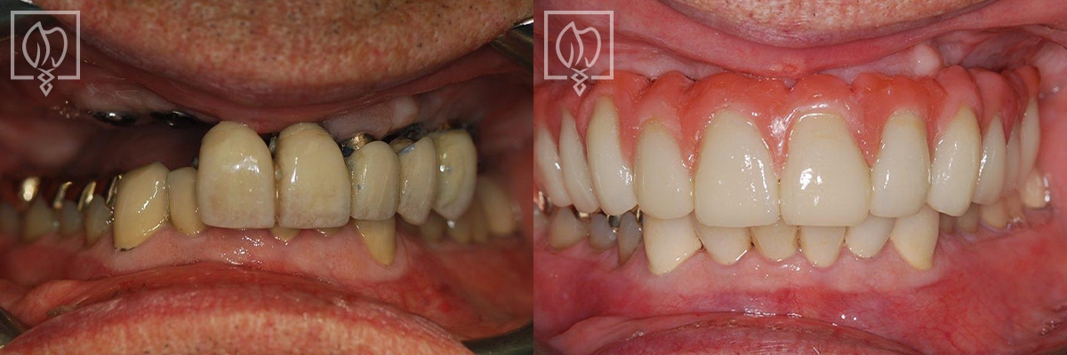 Dental Implant Before After Gallery Washington DC