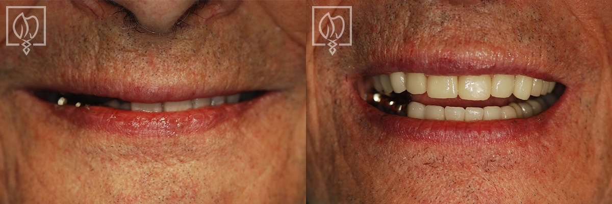 Dental Implant Before After Gallery Bethesda