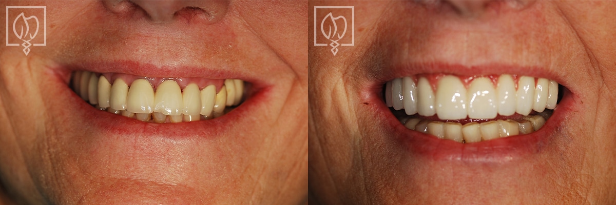 Dental Implant Before After Patient Washington DC
