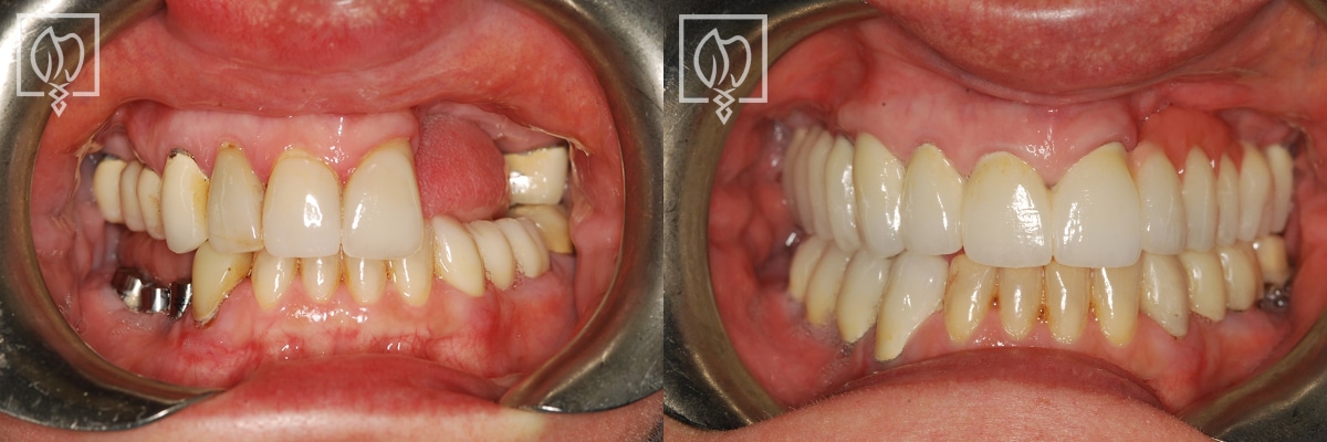 Restored Failing Dental Implant Before After Gallery Northern Virginia