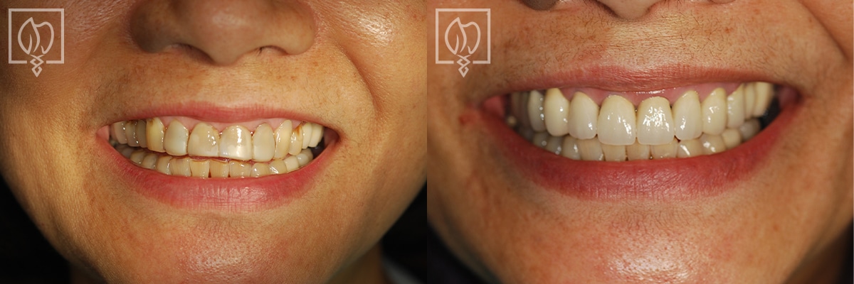 Discolored Teeth Before After Gallery Bethesda MD