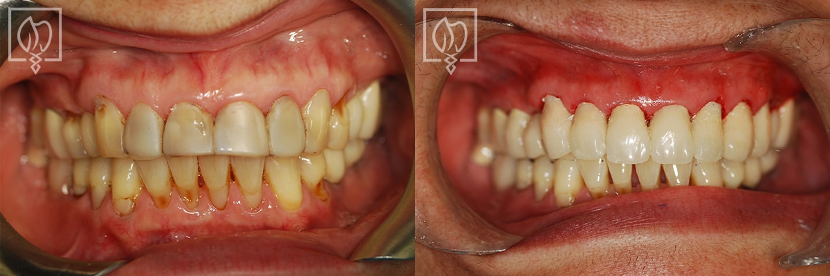 Discolored Teeth Before After Gallery Washington DC