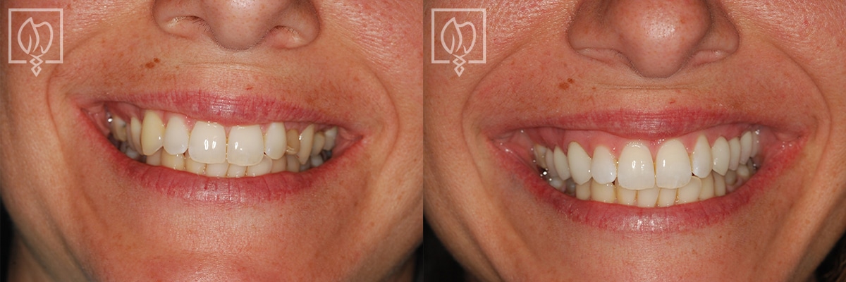 Cosmetic Smile Makeover Before After Gallery Potomac