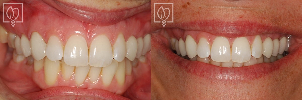 Cosmetic Smile Makeover Before After Gallery Chevy Chase