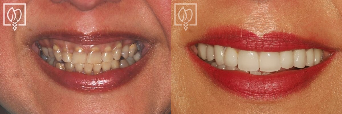 Cosmetic Smile Makeover Before After Gallery Bethesda