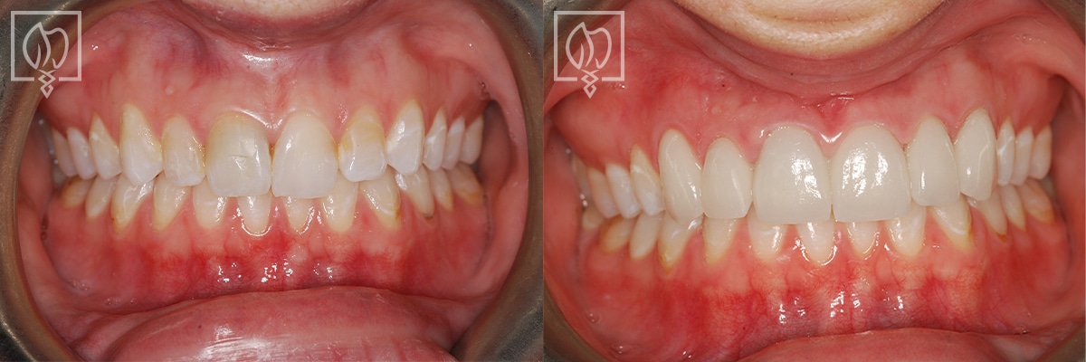 Discolored Teeth Before After Gallery Chevy Chase