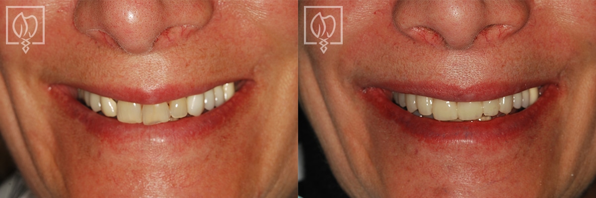 Cosmetic Smile Makeover Before After Gallery Washington DC