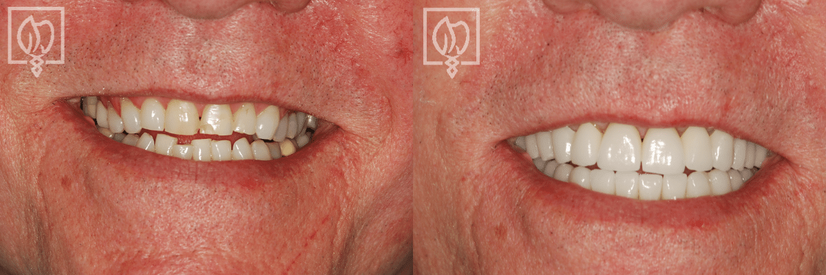 before and after patient prosthodontics Washington DC
