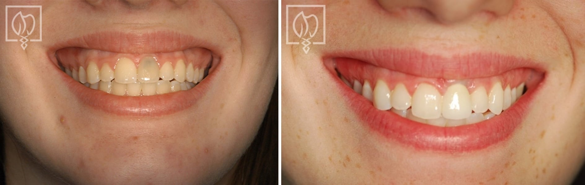 Photo of front tooth replacement with an implant before and after Bethesda, MD